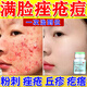 復方珍珠暗瘡片改善毛孔粗大去看黑頭醫用祛的痘消炎痤瘡硬疙瘩專(zhuān)用藥痘痘粉刺痘印治療粉刺膿包（視覺(jué)特效） 1盒裝【國藥正品保障】