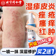 同仁堂皮炎濕疹噴劑皮膚瘙癢真菌感染止癢膏汗泡痤瘡疹私處瘙癢膏50ml