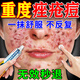 同仁堂祛痘消炎痤瘡專(zhuān)用青少年乳膏藥青春痘粉刺硬疙瘩修復消炎去除痘印 一盒裝(發(fā)貨特效快)