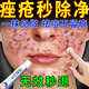 天池七草祛痘消焱青少年痤瘡專(zhuān)用乳膏青春痘粉刺硬疙瘩修復消焱去除痘印 W 一盒裝【一抹見(jiàn)傚】