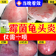 龜頭炎專(zhuān)用藥真菌感染龜頭炎噴劑龜頭感染消炎藥龜頭炎包皮炎癥專(zhuān)用男科用藥鹽酸特比萘芬噴霧劑 一盒【龜頭紅點(diǎn)紅斑不痛不癢專(zhuān)用藥】