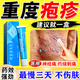 阿昔洛韋乳膏凝膠軟 帶狀皰疹后遺癥神經(jīng)痛用藥斷貨根 蛇盤(pán)瘡生殖器皰疹也可用抗病毒軟膏【視覺(jué)特效】 1盒【建議多盒使用】