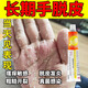手脫皮嚴重脫皮真菌蛻皮干燥起皮用什么藥手足癬真菌感染藥膏脫皮開裂鵝掌風皮膚用藥醋酸曲安奈德益康唑乳膏 1盒裝 【手掌脫皮專用藥 手腳脫皮藥膏】
