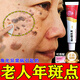 維a酸乳膏角化異常引起老人年斑臉部手背祛斑點(diǎn)斑專(zhuān)用OTC藥霜水去老人年斑專(zhuān)用OTC藥一皮夜 1盒