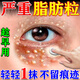 脂肪粒去除眼部油脂粒消除汗管瘤眼部周?chē)鷮?zhuān)用眼霜油脂粒涂抹藥膏 一盒裝【體驗款】