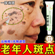 va酸乳軟膏維a酸乳膏去老年斑專(zhuān)用藥一夜消祛斑男士專(zhuān)用去除老年斑特水效藥強力祛除手部臉部祛斑美白淡霜 3【長(cháng)年頑固老年斑滿(mǎn)臉都是不敢出門(mén)】從跟消斑更徹底