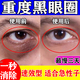 黑眼圈重度去除黑色素男士專(zhuān)用眼部黑色素沉淀嚴重度去除淡化細紋眼霜提拉緊致女士?jì)和鬯钛鄞t霉素眼膏 1盒【黑眼圈去除男女士】