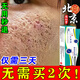 痘印痘坑修復男士凹洞祛痘去痘印去閉口粉刺去黑頭痘坑祛痘疤膏藥 1盒裝【無(wú)買(mǎi)贈試用】 去痘痘和痘印淡化消除填充再生凝膠生長(cháng)因子女男生醫用