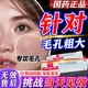 阿達(dá)帕林凝膠改善毛孔粗大去看黑頭醫(yī)用 祛痘消炎痤瘡專用青少年 正品臉上長痘痘專用藥京東自官營方旗艦店 3盒療程【堅(jiān)持一個(gè)月 毛孔再見】