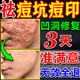勝典方痘印痘坑修復凹洞祛痘印去痘印淡化黑色素淡化痘坑男士祛痘疤膏藥 一盒【專(zhuān)業(yè)祛痘坑神器】 去痘痘和痘印淡化消除填充再生凝膠生長(cháng)因子女男生醫用