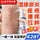 同仁堂皮炎濕疹噴劑皮膚瘙癢真菌感染止癢膏汗泡痤瘡疹私處瘙癢膏3盒