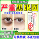 去黑眼圈專(zhuān)用眼部黑色素沉淀黑眼圈重度去除黑色素男女士專(zhuān)用補水保濕滋潤黑眼圈祛眼袋皮膚用藥紅霉素眼膏 1盒【去黑眼圈眼膏】