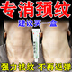 維A酸乳膏頸紋霜去頸紋淡化頸紋提拉緊致頸紋去除神器脖子黑色素去除沉淀治黑棘皮病癥藥膏專(zhuān)用醫用級黑棘皮 一盒【淡化頸紋專(zhuān)用藥膏】