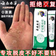 云南本草手足脫皮膏 手指上起皮干燥手掌嚴重蛻皮脫皮手心手腳掉皮止癢膏 云南本草手足脫皮藥膏1盒20g/盒