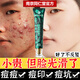百幽草南京同仁堂水楊酸祛痘膏面霜淡化痘印痘疤痘坑男女士學(xué)生 一瓶裝【按療程使用效果更佳】