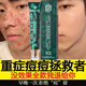 同仁堂祛痘膏去痘痘和痘印痘坑修復男女士改善粉刺閉口30g圣誕節禮物