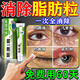 協(xié)和奕然堂汗管瘤專(zhuān)用眼部脂肪粒去除神器藥膏消散眼周長(cháng)白色小顆粒扁平黃疣 單盒【體驗裝】 北京協(xié)和 專(zhuān)消脂肪粒