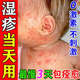 山本中村制薬嬰兒童寶寶濕疹膏嬰幼兒專(zhuān)用濕疹膏無(wú)激素0-3歲抑菌止瘙癢膏皮炎 一盒裝【寶寶濕疹霜】多買(mǎi)多送 頑固寶寶身體乳止癢保濕止癢干性濕疹日本原裝進(jìn)口去根