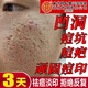 同仁堂祛痘印痘坑修復淡化痘坑修復凹洞黑色素沉淀淡化去痘痘和痘印粉刺 一盒裝【祛痘淡印】