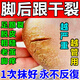 奕康本草裂手腳干裂腳后跟龜裂膏角專(zhuān)用滋潤膏足跟部皸皴裂膏口子買(mǎi)什么藥 單盒裝【多買(mǎi)多送】 腳起硬皮去除腳后跟繭裂口子起皮真菌干癢粗糙起老厚皮