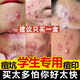 同仁堂學(xué)生祛痘藥膏去痘痘和痘印青春痘坑淡化痘印青少年痤瘡男女20g