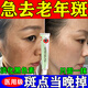 祛斑點(diǎn)斑專(zhuān)用藥水醫用級祛斑效果最好的產(chǎn)品維a酸乳膏去老年斑的藥強力去除手部臉部黃褐雀曬斑女士用黑色素 1盒【祛斑男女士專(zhuān)用】維a酸乳膏祛斑專(zhuān)用藥醫用正品