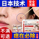 日本點(diǎn)痣膏去痣水臉部去痦子黑痣祛痣點(diǎn)斑魚(yú)鱗痣無(wú)痕修復不留疤 【日本技術(shù) 專(zhuān)研配方】1套