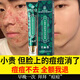 同仁堂祛痘膏去痘痘和痘印痘坑修復男女士改善粉刺閉口30g