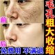 男士收縮毛孔粗大修復(fù)細(xì)致醫(yī)用鼻子去黑頭和閉口粉刺堵塞祛痘藥膏 買五送三【孔粗大 黑頭閉口粉刺】 去毛孔粗大醫(yī)用修復(fù)收縮女精華液