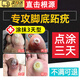 OIMG跖疣專(zhuān)用膏藥跖疣腳底趾疣去i根專(zhuān)用特hpv貼腳上跖疣雞眼猴子肉刺 特效膏