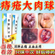 [黑寶]熊膽痔靈膏 痔瘡膏去肉球內外混合痔瘡專用藥痔瘡藥去肉球斷痔根痔消痔治斷止痛肛門瘙癢醫用凝膠 10g 2盒裝 【內痔 外痔 混合痔】