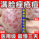 清熱解毒去痤瘡丸臉上去痘痘的藥痤瘡丸祛痘膿皰瘡下巴紅腫硬去痘痘和痘印修復淡化痘印去粉刺 清熱暗瘡丸 3盒療程裝【額頭臉頰下巴都是痤瘡痘】