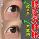 葵花腫眼泡去脂消腫藥貼眼部脂肪厚眼皮松弛去水腫熬夜紅腫發(fā)炎專(zhuān)用貼 單盒裝