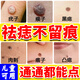 鵲醫(yī)世家點(diǎn)痣膏藥水無(wú)痕臉部疤痕修復(fù)美容院專用溫和祛痣套裝黑點(diǎn)無(wú)痛