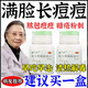臉上去痘痘的藥 治痤瘡粉刺臉上反復長痘痘青春痘熬夜長痘男女內(nèi)分泌失調(diào)痘痘中藥調(diào)理祛痘復方珍珠暗瘡片 1盒【中藥祛痘】建議多盒