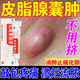 皮脂腺囊腫專用藥膏去癢除皮下皮脂腺硬塊紅腫痘痘火癤子粉瘤囊腫毒疙瘩消炎抗菌止癢化膿潰瘍感染紅霉素軟膏 1盒裝【紅腫硬疙瘩】