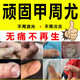 carelead甲周疣兒童甲下疣專用手指增生去腳趾緣疣長疣去甲旁疣甲溝疣膏