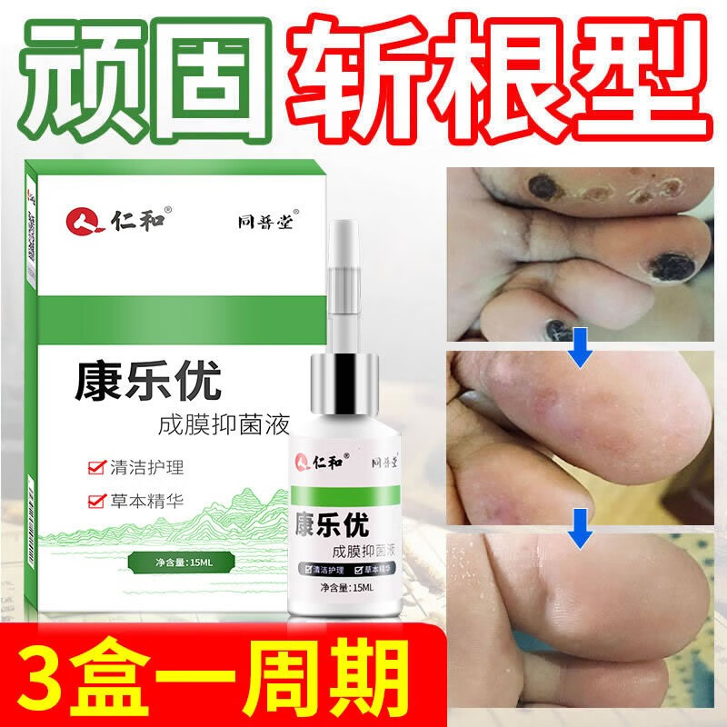 仁和鸡眼膏鸡眼液去脚根足部手部跖脚底疣脚垫祛茧膏去除子瘊刺肉疣