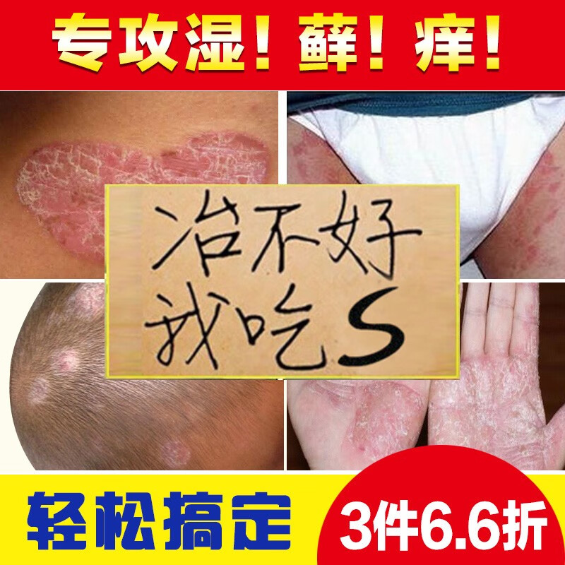 民间郎中【去藓专家】顽固牛皮银屑股藓股癣膏1盒/20g