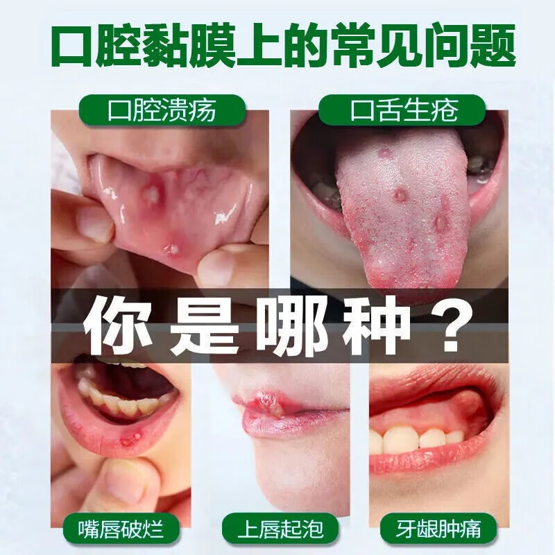 【otc】治口腔溃疡药缺锌引起的反复口腔溃疡口疮嘴巴烂舌头起泡口内