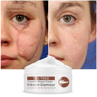 

Repair Face Cream Acne Scar Removal Whitening for Spots Acne Treatment Stretch Marks Skin Care Cream