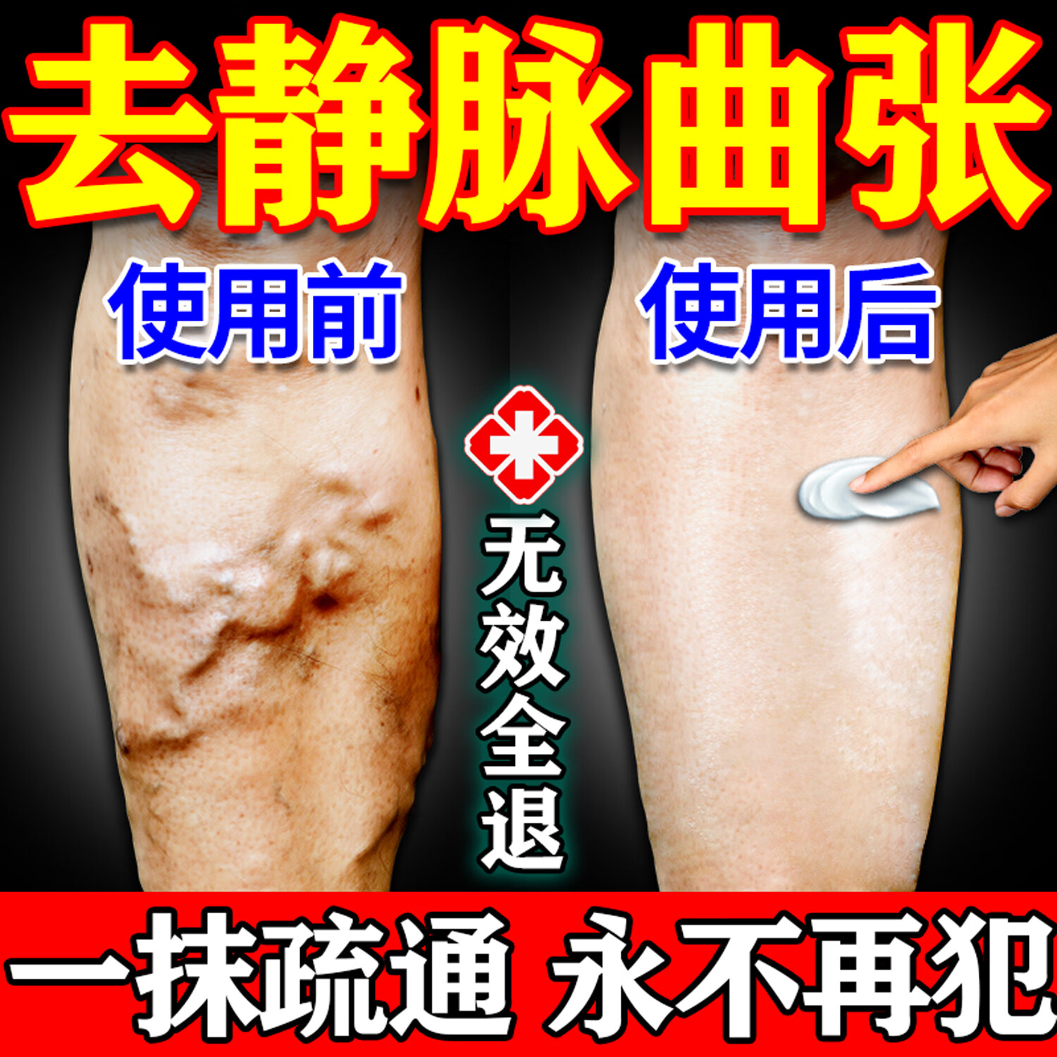 佩措琛克静脉曲张100%专用贴蚯蚓腿血管堵塞青筋凸起疏通进口药膏冷敷