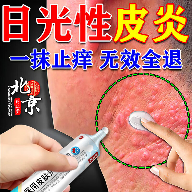 日光性皮炎专用膏药治疗太阳晒伤修复紫外线过敏瘙痒光敏性止痒膏 1