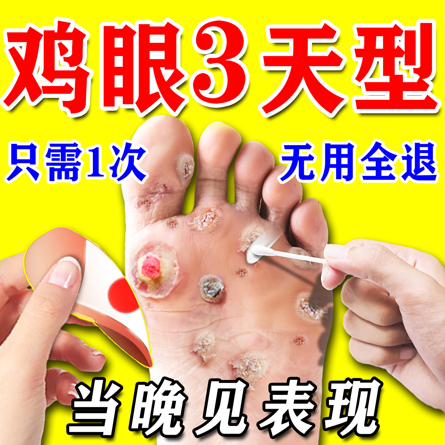 乔记鸡眼膏贴去除根肉刺猴药膏无痛脱落连根拔去硬老茧疣鸡眼专用非药