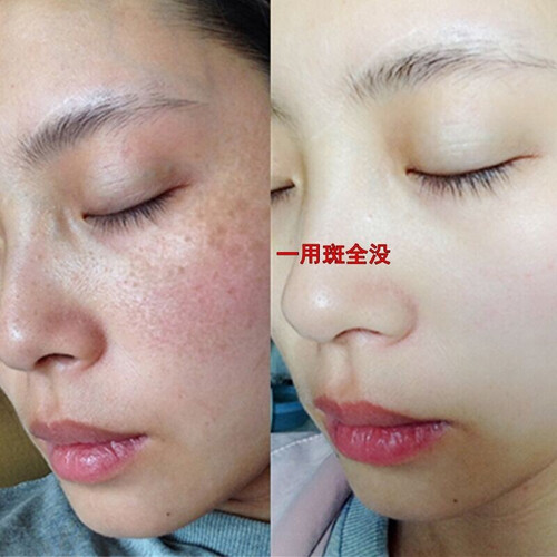 肌肤之食 玻尿酸原液虾青素小安瓶美白淡化斑精华液祛去斑补水提亮肤色抗氧化正品男女 买5赠3【两周期装】恢复婴儿肌