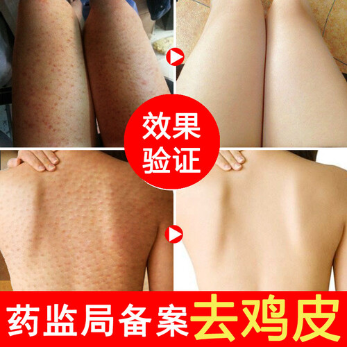 魅魔 去鸡皮肤去角质鱼鳞皮肤毛囊鸡皮疙瘩润肤身体乳药膏皮肤霜浴盐大腿干燥毛周角化修护精华 大面积顽固鸡皮肤（买4送3发7瓶）