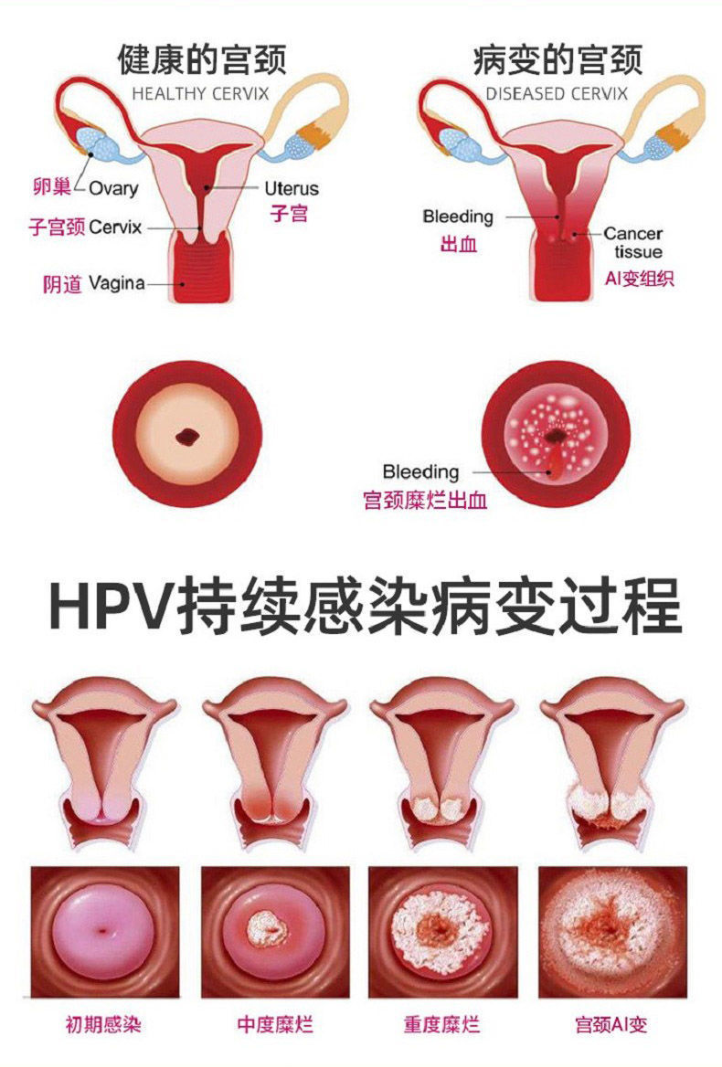 女性hpv病毒早期症状图片