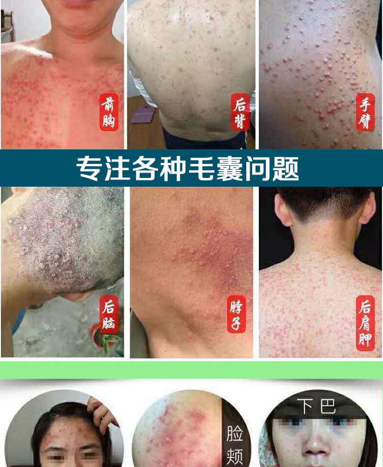 【官方直售】鹭凤堂云南本草百肤灵毛囊炎头部胸部后背脸部痘痘脓疮包