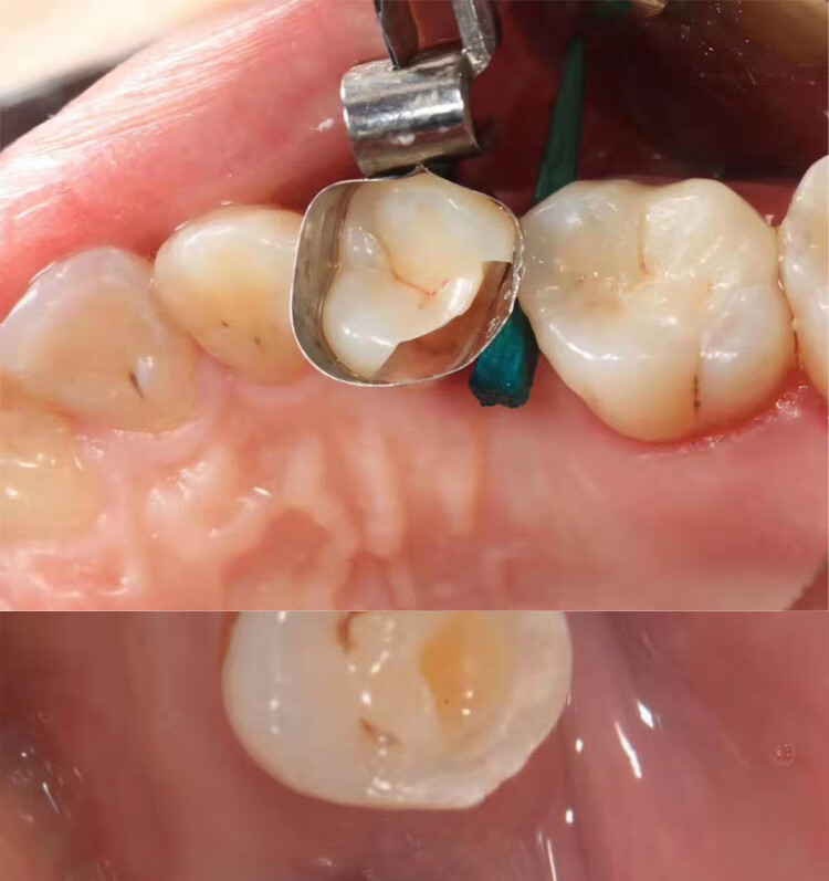 牙科材料牙医公园龈壁提升套装豆瓣成型片补牙套装深边缘移位 不锈钢