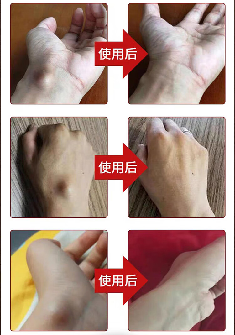 菲诗伊人【官方旗舰】柯瑞森四号腱鞘手指手腕大拇指疼痛网球肘护腕